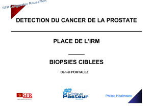 detection du cancer de la prostate place de l`irm _____ biopsies