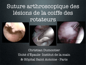 Coiffe: suture arthroscopique C. Dumontier