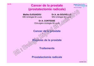 Cancer de la prostate