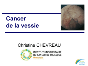 83. cancer de la vessie_Dr Chevreau