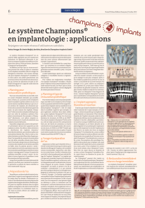 Le système Champions® en implantologie : applications