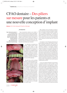 CFAO dentaire – Des piliers sur mesure pour les patients et une