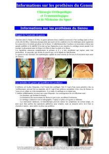 Informations sur les prothèses du Genou Chirurgie