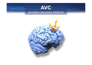 AVC : La prise en charge