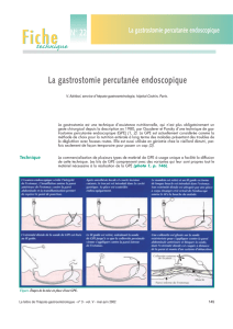 Gastrostomie percutanée endoscopique
