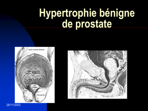 Hypertrophie bénigne de prostate