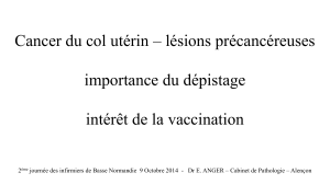 Cancer du col utérin – lesions précancereuses importance du