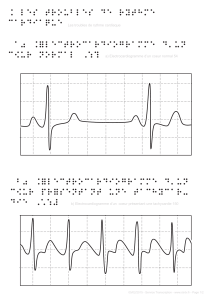 ¨ Les troubles de rythme cardiaque a) ¨électrocardiogramme d’un c9ur normal `54