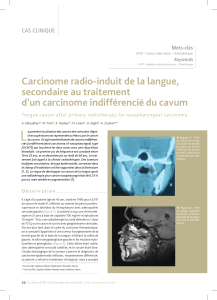 L Carcinome radio-induit de la langue, secondaire au traitement