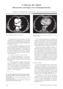 L’image du mois dissection aortique avec hémopéricarde D. S (1),  e. B