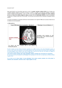 Correction Tp 27  accident vasculaire cérébral (AVC)