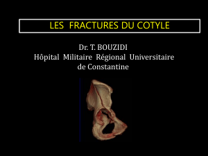 LES  FRACTURES DU COTYLE Dr. T. BOUZIDI de Constantine