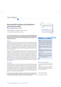 Neuropathie optique rétrobulbaire gauche présumée Cas clinique Presumed left optic neuritis