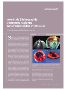 Intérêt de l’échographie transœso phagienne dans l’endocardite infectieuse IMAGE COMMENTÉE