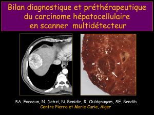 Bilan diagnostique et préthérapeutique du carcinome hépatocellulaire en scanner  multidétecteur