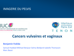 Cancers vulvaires et vaginaux  Benjamin Fedida Samuel Haddad-Mikhael Benjoar-Selma Beldjord-Isabelle Thomassin-