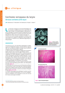 L Carcinome verruqueux du larynx C