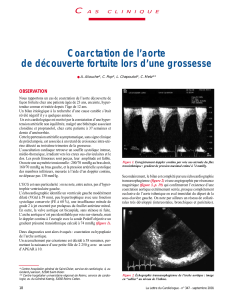 Coarctation de l’aorte de découverte fortuite lors d’une grossesse C OBSERVATION
