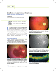 L Une hémorragie rétrohyaloïdienne Clin d’œil A dense premacular hæmorrhage