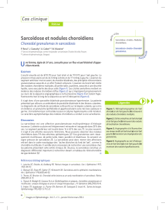 Sarcoïdose et nodules choroïdiens Cas clinique Choroidal granulomas in sarcoidosis