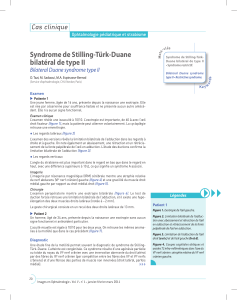 Syndrome de Stilling-Türk-Duane bilatéral de type II Cas clinique