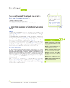 Neurorétinopathie aiguë maculaire Cas clinique Acute macular neuroretinopathy