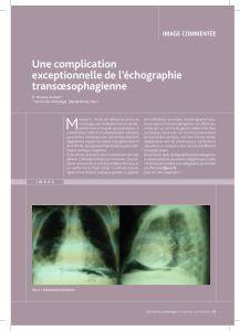 M Une complication exceptionnelle de l’échographie transœsophagienne