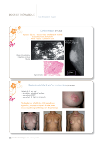 DOSSIER THÉMATIQUE Gynécomastie Mastectomie bilatérale/reconstruction Cas cliniques en images