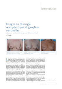 Images en chirurgie oncoplastique et ganglion sentinelle DOSSIER THÉMATIQUE