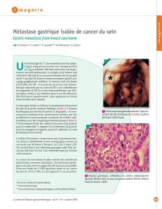 U Métastase gastrique isolée de cancer du sein I