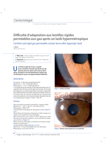 U Diﬃculté d’adaptation aux lentilles rigides Contactologie