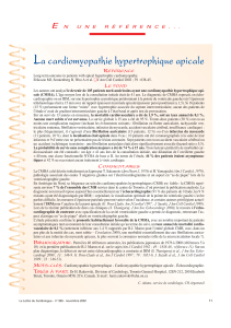 L a cardiomyopathie hypertrophique apicale R
