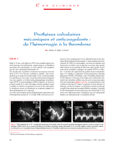 Prothèses valvulaires mécaniques et anticoagulants : de l’hémorragie à la thrombose C