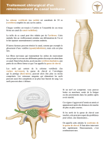 Traitement chirurgical d`un rétrécissement du canal lombaire