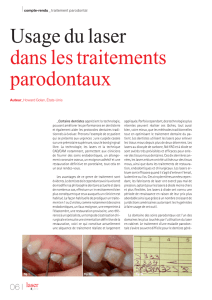 Usage du laser dans les traitements parodontaux