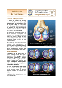 Déchirure du ménisque