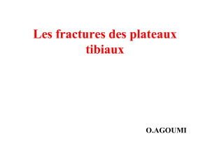 FRACTURES  DES PLATEAUX TIBIAUX-converted
