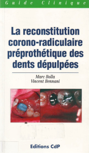 La reconstitution corono-radiculaire prothétique des dents dépulpés
