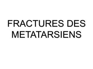 fracture metatarsien