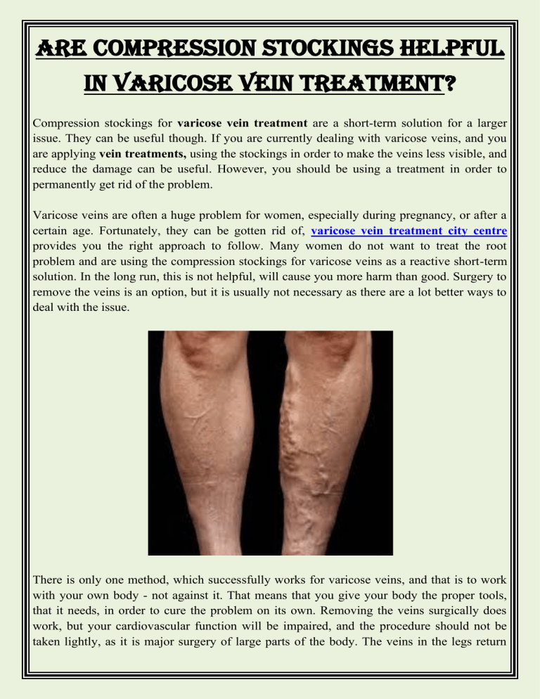 Are compression stockings helpful in varicose vein treatment