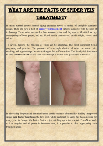 What are the Facts of Spider Vein Treatment