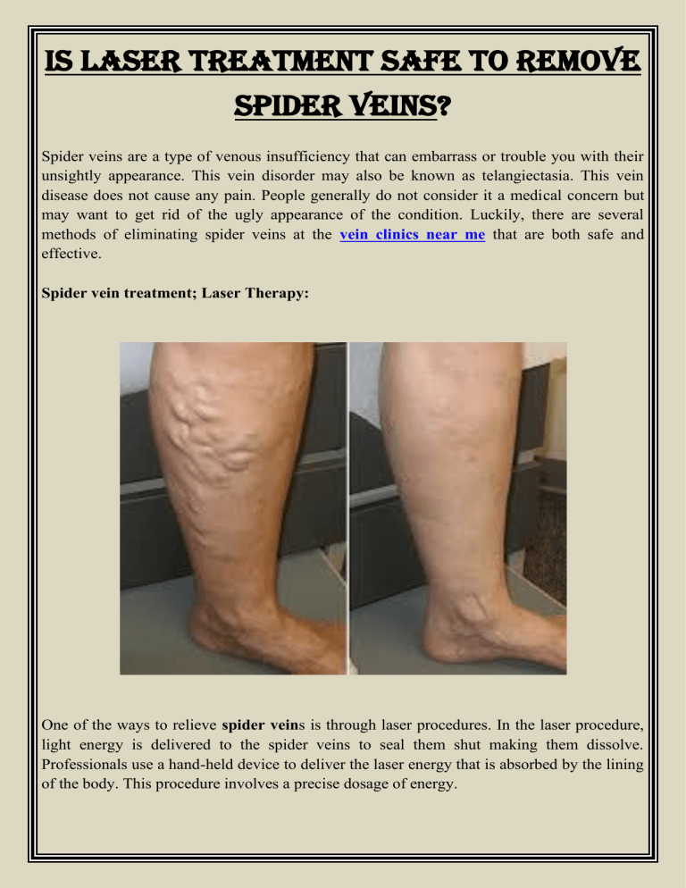 is-laser-treatment-safe-to-remove-spider-veins