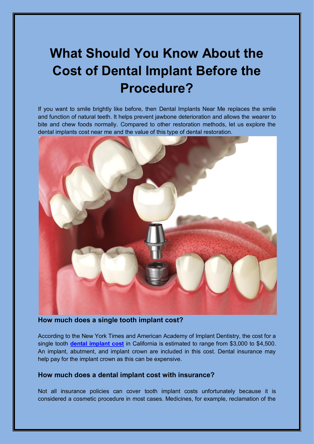 What Should You Know About The Cost Of Dental Implant Before The Procedure