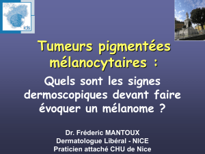 Dermoscopie Signes positifs et negatifs melanome  -  Algorythmes diagnostic