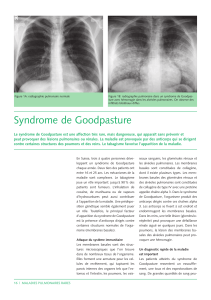 vivo2 02-2010 f syndrome goodpasture (1) (1)