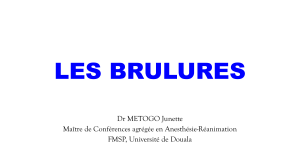 Les Brûlures : Définition, Physiopathologie et Prise en Charge