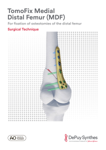 TomoFix Medial Distal Femur (MDF) Surgical Technique