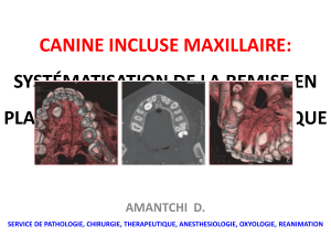 Canine incluse maxillaire : syst&eacute;matisation de la remise en place chirurgico-orthodontique
